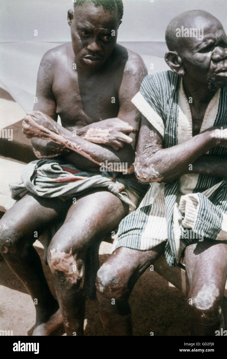 medicine, diseases, leprosy, patients in a German leprosy ward in Africa, 1962, Additional-Rights-Clearences-Not Available Stock Photo