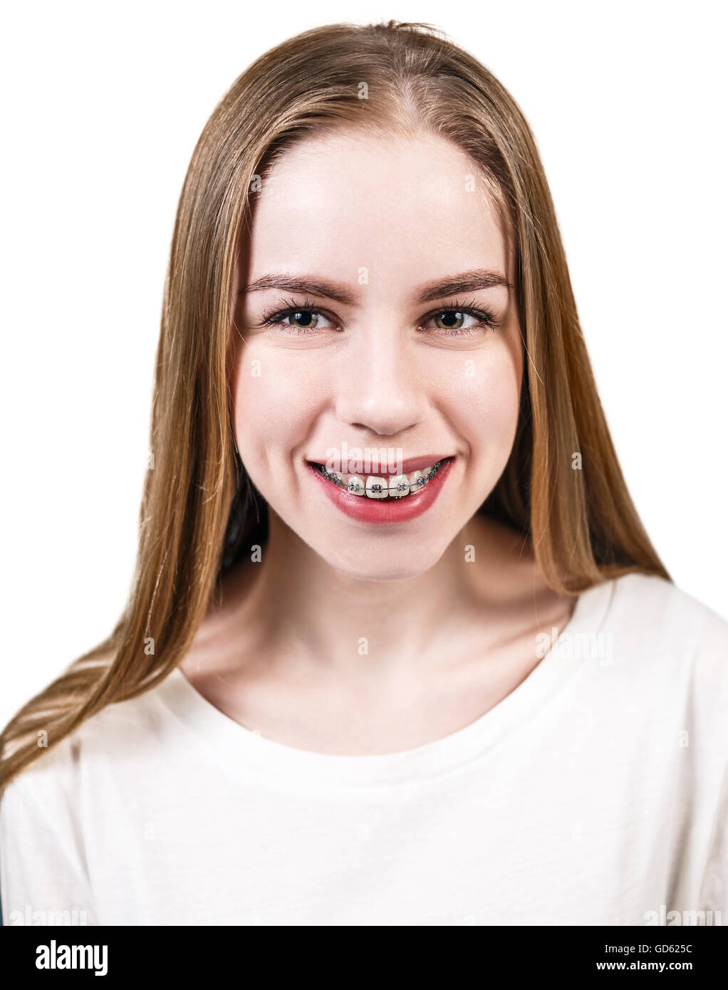 Beautiful woman with braces on teeth Stock Photo - Alamy