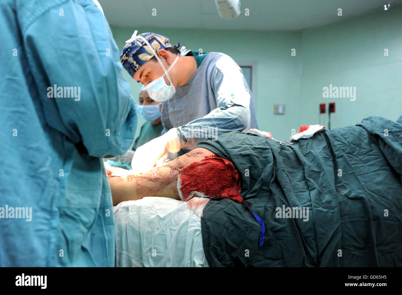 A skin graft surgery for ulcer on electrocuted patient in Roosevelt Hospital in Guatemala City. Stock Photo