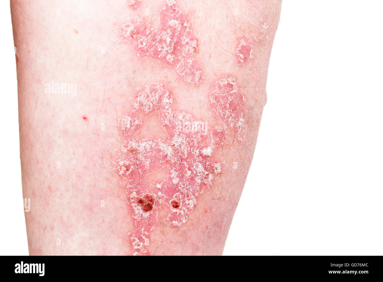 Psoriatic High Resolution Stock Photography And Images Alamy