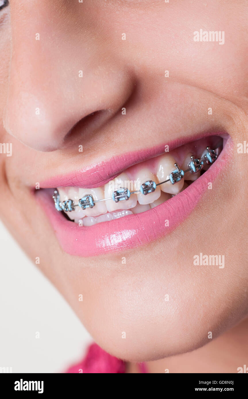 Corrective braces on a teens teeth hires stock photography and images