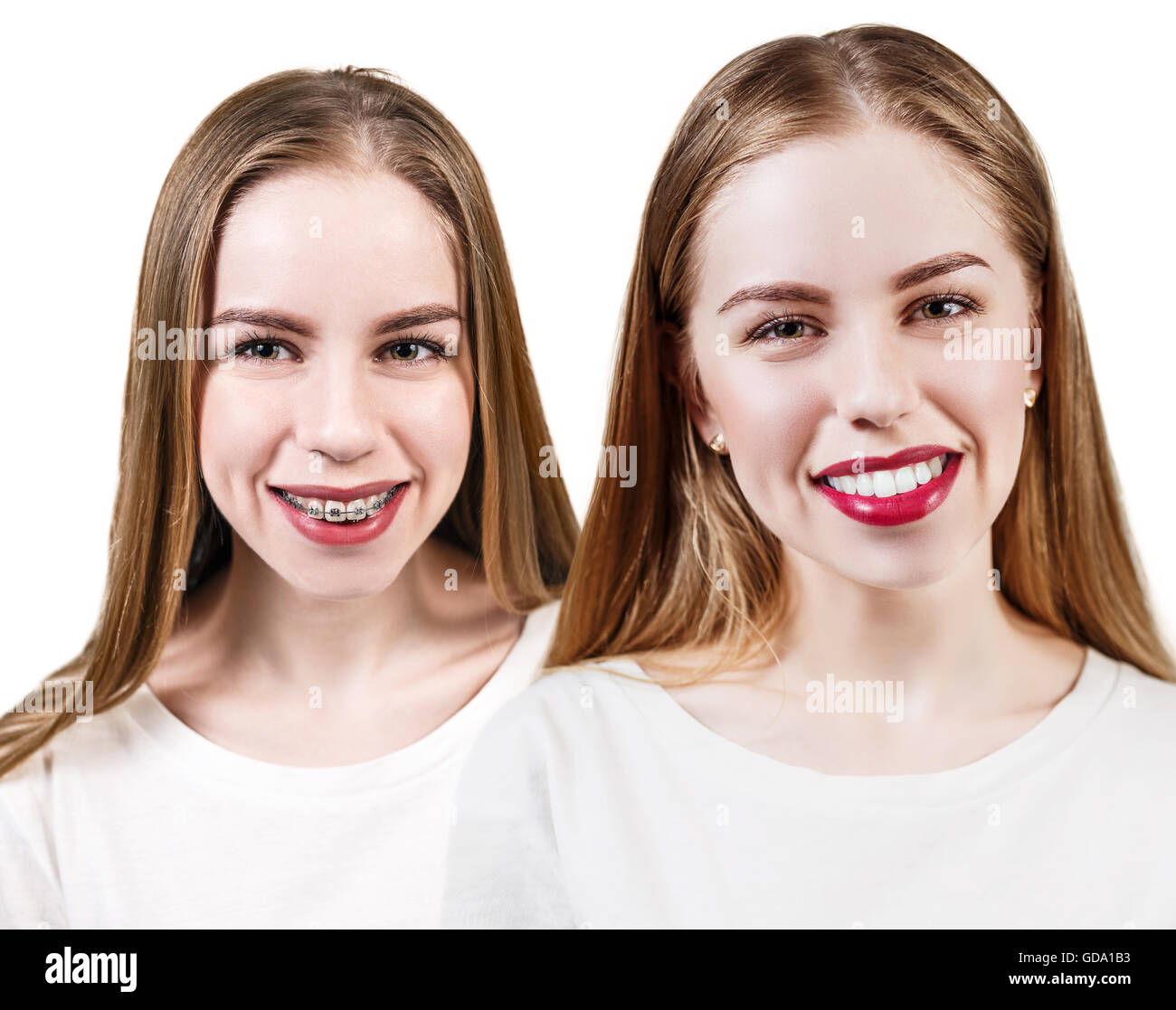 Perfect teeth before and after braces Stock Photo Alamy