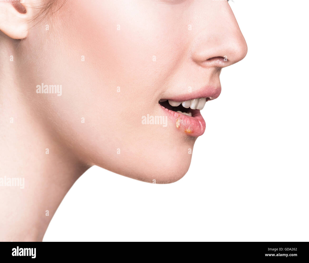 Beautiful lips infected herpes virus Stock Photo