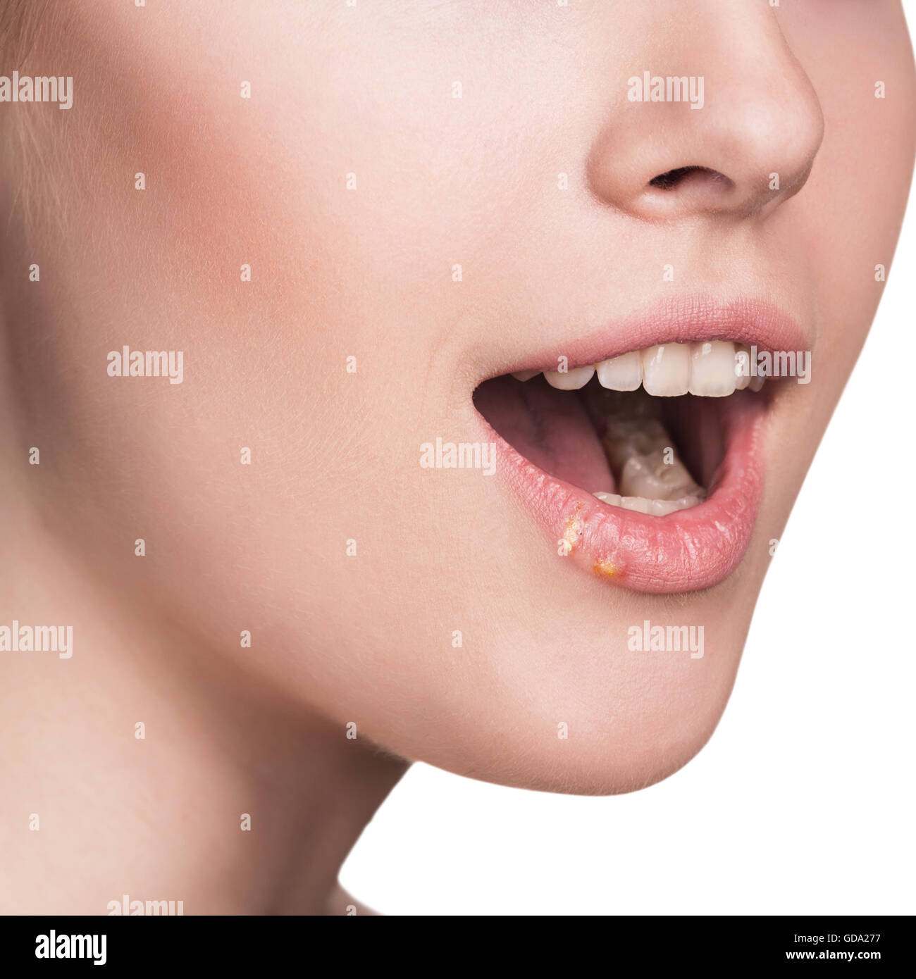 Beautiful lips infected herpes virus Stock Photo