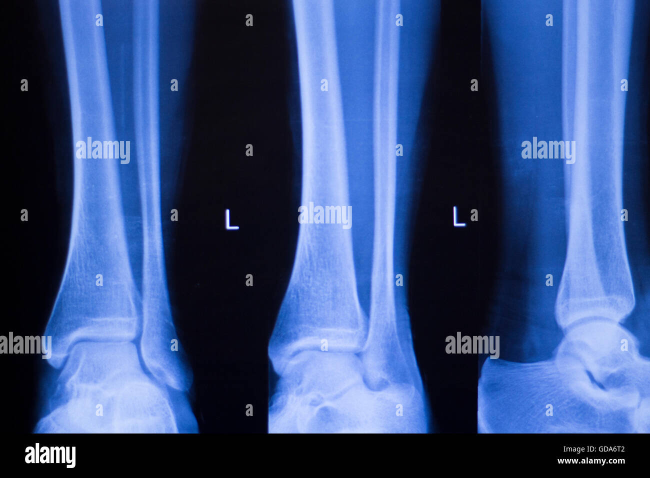 Foot, heel and ankle xray traumatology and orthopedics test medical