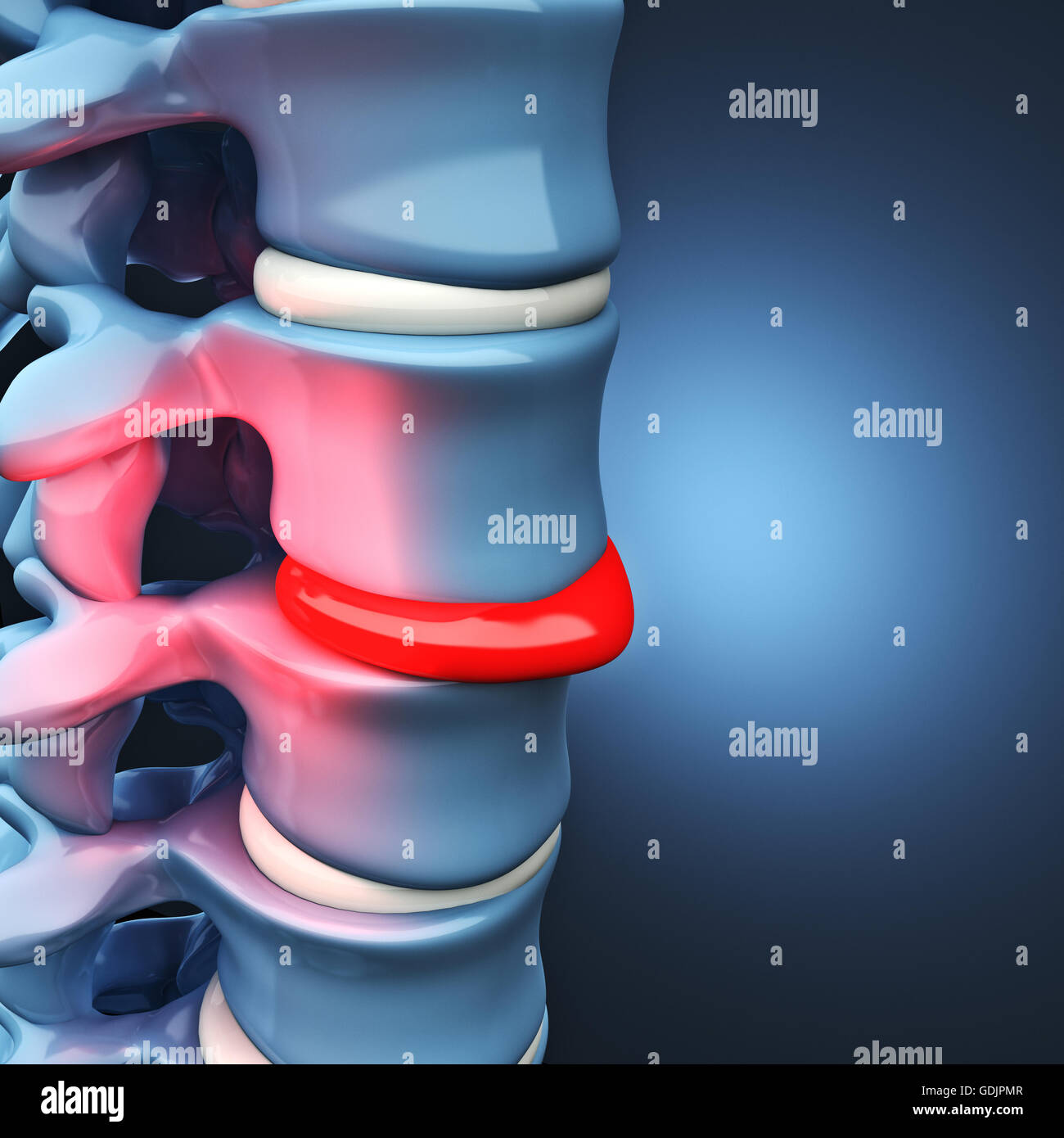 Herniated disc hires stock photography and images Alamy
