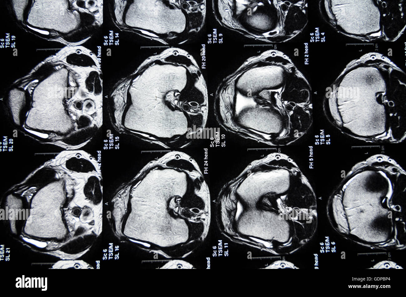 : Magnetic Resonance Imaging ( MRI ) : cross-sectional images of a knee, , , Stock Photo