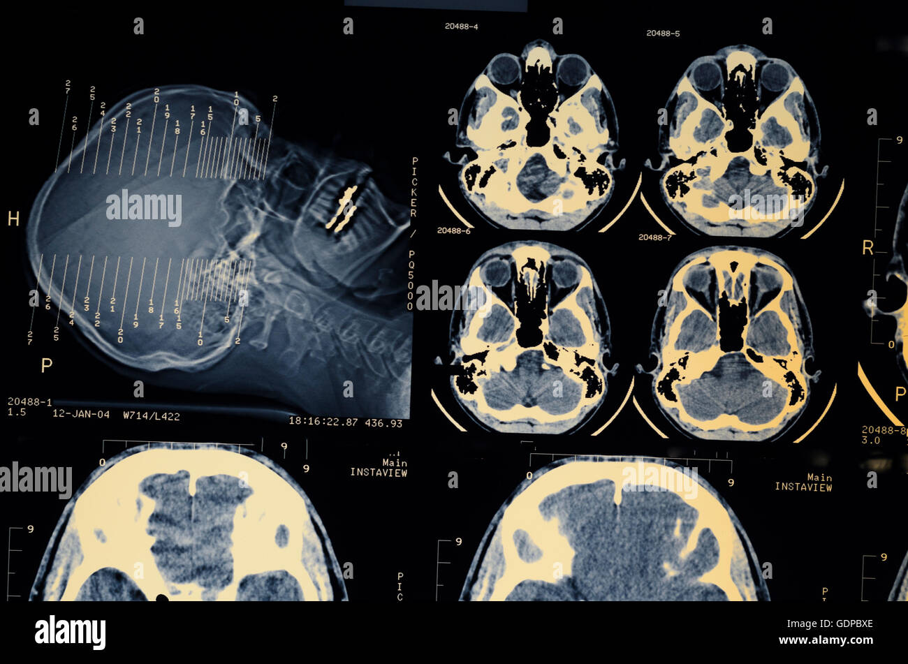 : Magnetic Resonance Imaging ( MRI ) : cross-sectional images of the head , eyes, teeth filled with amalgam, brain, , , Stock Photo