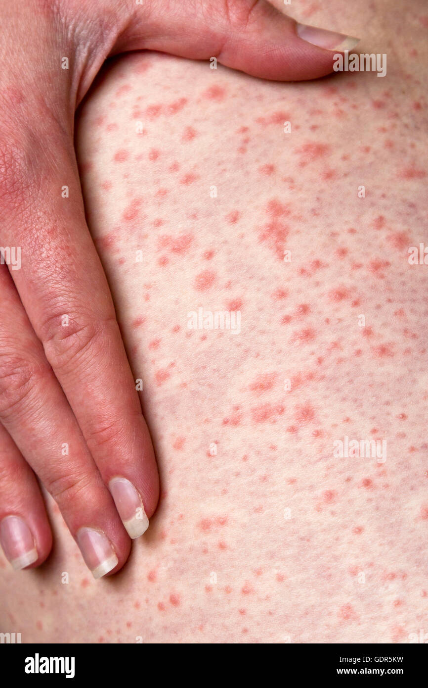 An urticarial rash caused by an allergic reaction to penicillin Stock Photo