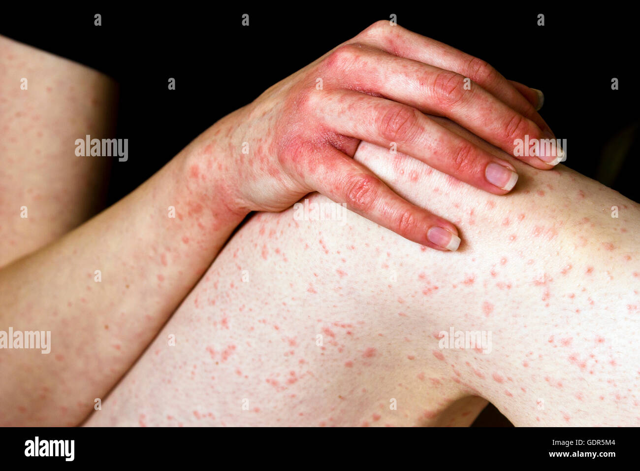 An urticarial rash caused by an allergic reaction to penicillin Stock Photo