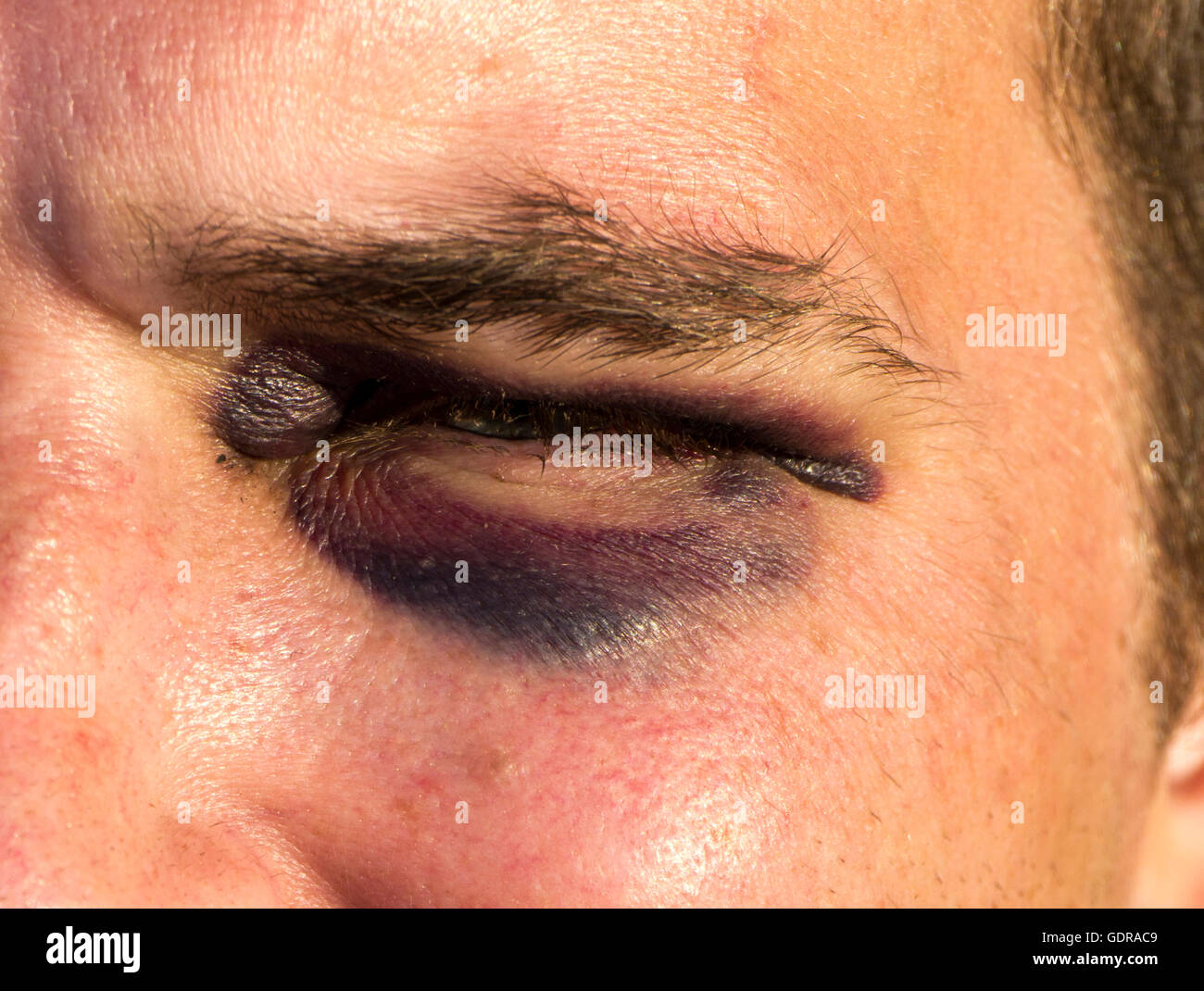 Close up of a Black eye Stock Photo