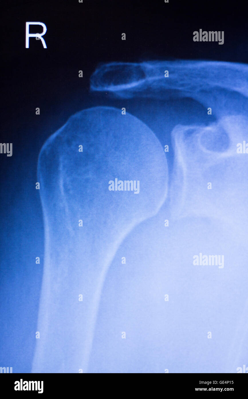 Shoulder joint injury xray traumatology and orthopedics test medical scan used to diagnose