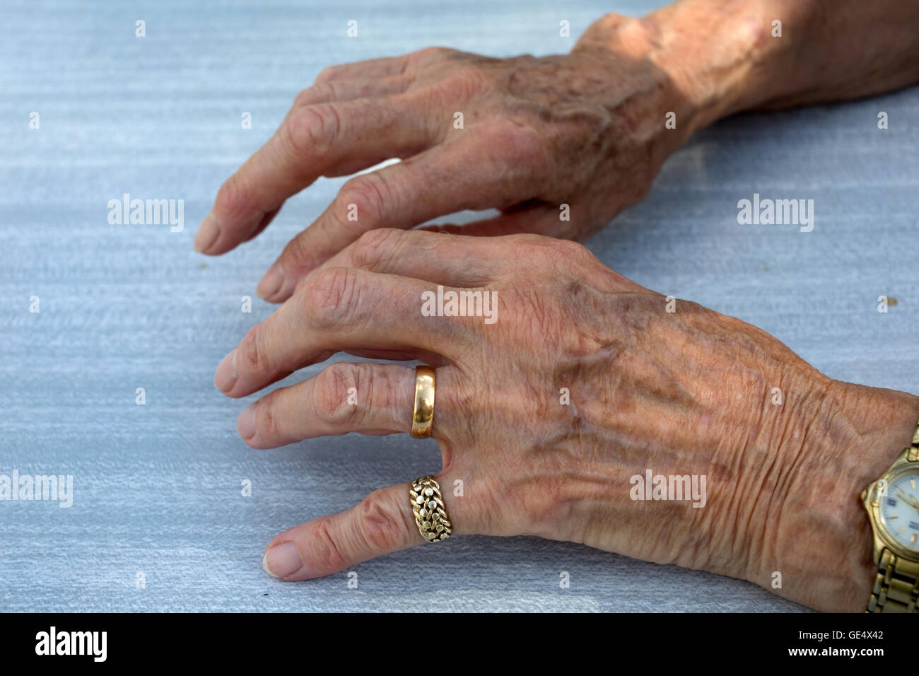 Rheumatoid arthritis hands hi-res stock photography and images - Alamy