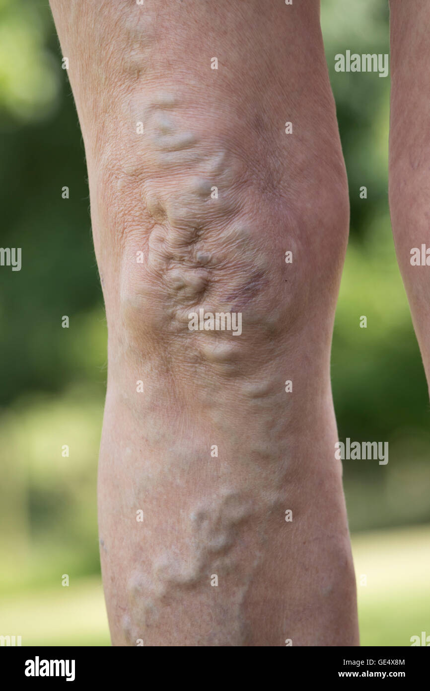 Varicose veins swollend enlarged veins and distorted skin in knees and legs of elderly woman UK Stock Photo