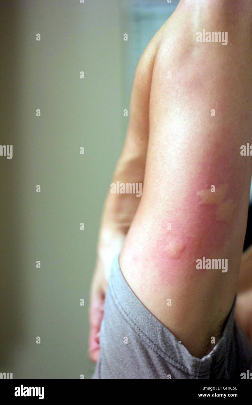 3 mosquito bites on arm Stock Photo Alamy