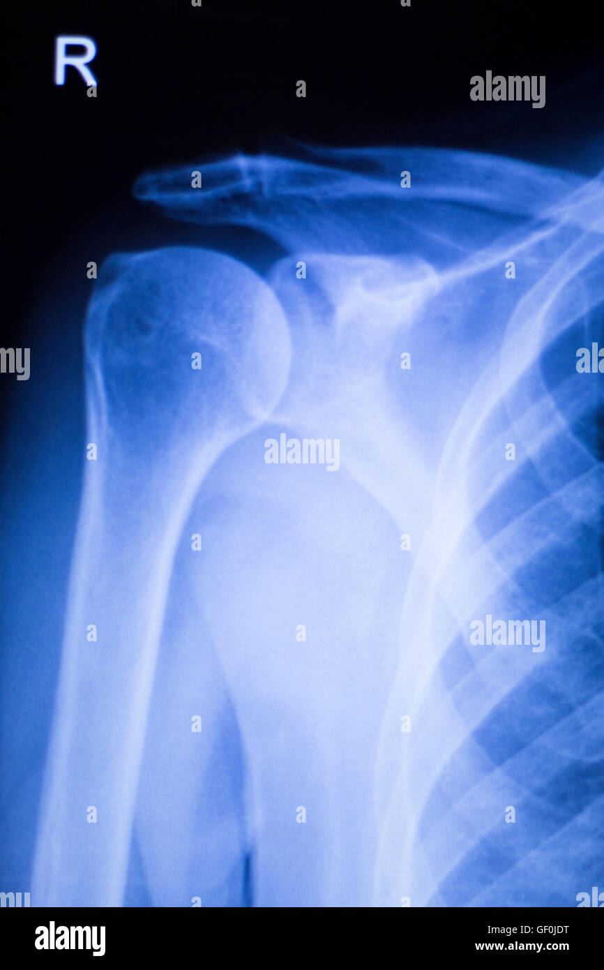 Shoulder joint injury xray traumatology and orthopedics test medical scan used to diagnose