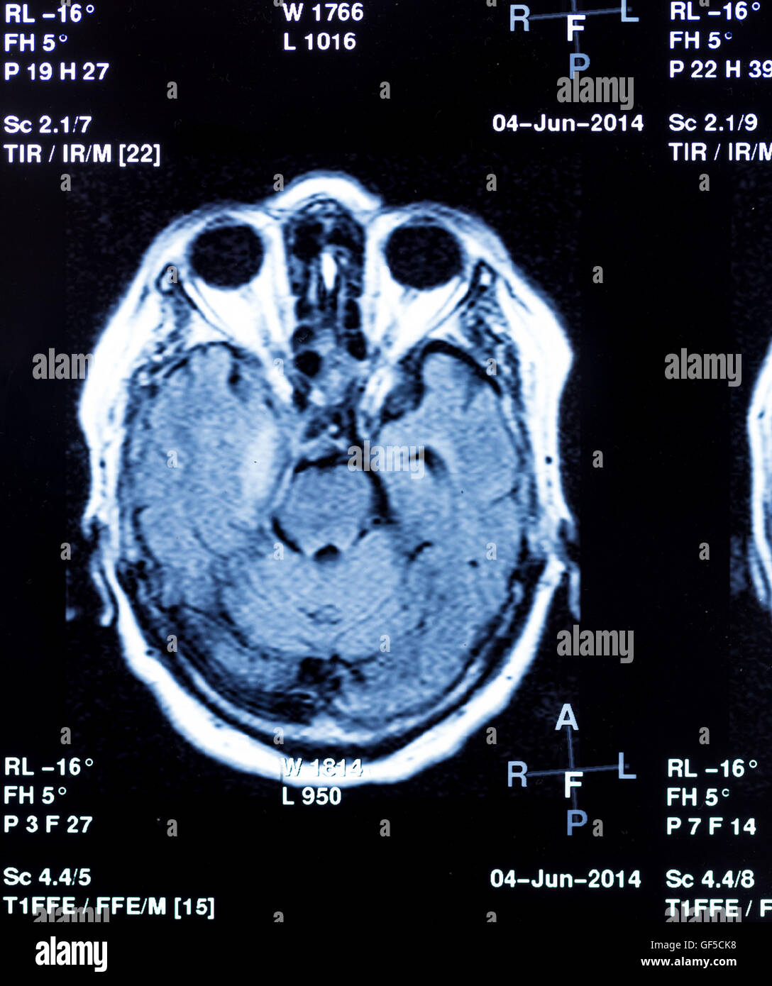 brain scan with tumor
