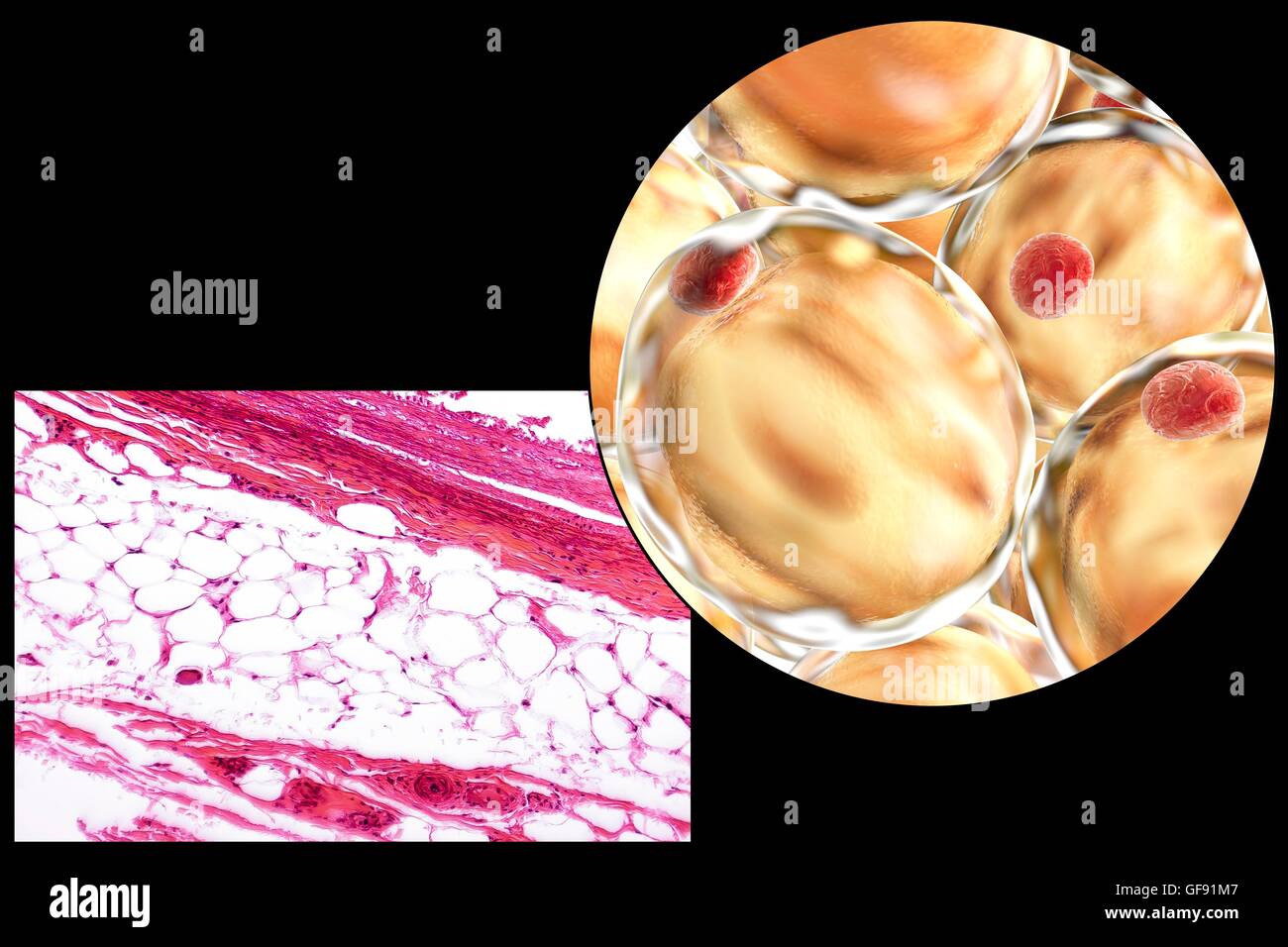 Fat cells, light micrograph and computer illustration. White adipose tissue composed of adipocytes (fat cells). Adipocytes form adipose tissue, which stores energy as an insulating layer of fat. White adipose tissue is used as a store of energy but also a Stock Photo