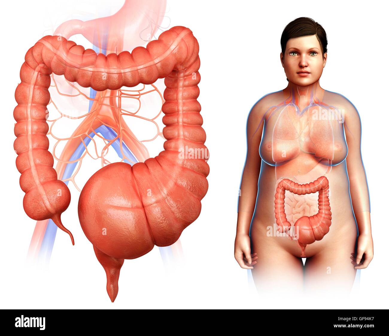 Сигмовидная кишка долихосигма. Долихосигма непроходимость кишечная. Дополнительная петля сигмовидной кишки. Сигмовидная кишка долихосигма. Толстый кишечник долихосигма.