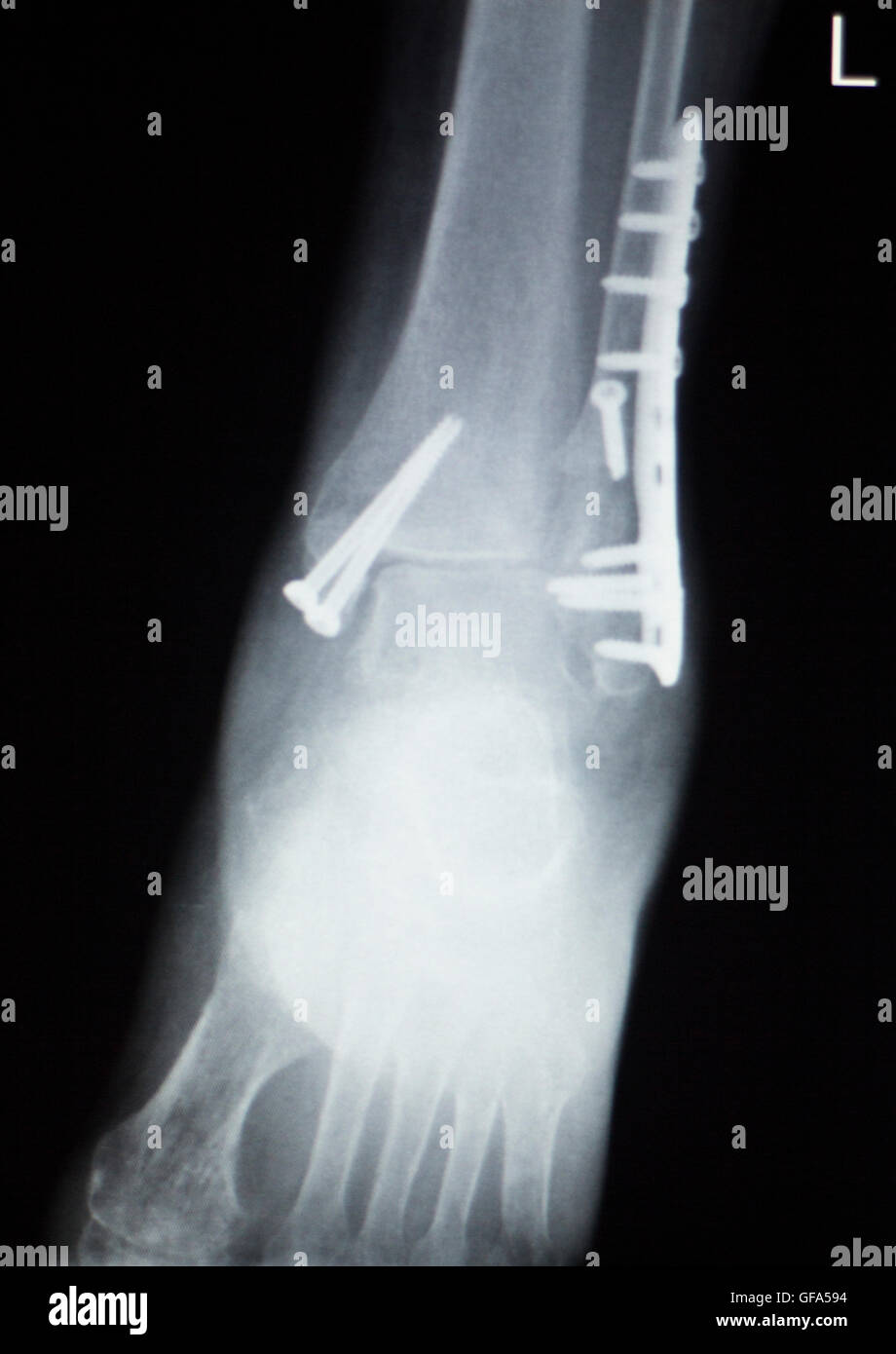 Ankle Foot Joint Orthopedic Titanium Metal Traaumatology Plate And Screw Implant X Ray Image Of Injured Patient Stock Photo Alamy