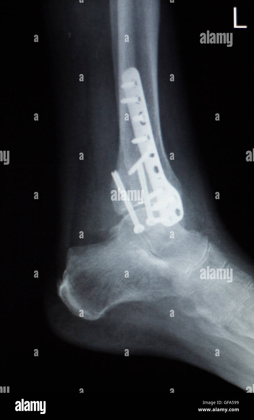 Ankle foot joint orthopedic titanium metal Traaumatology plate and