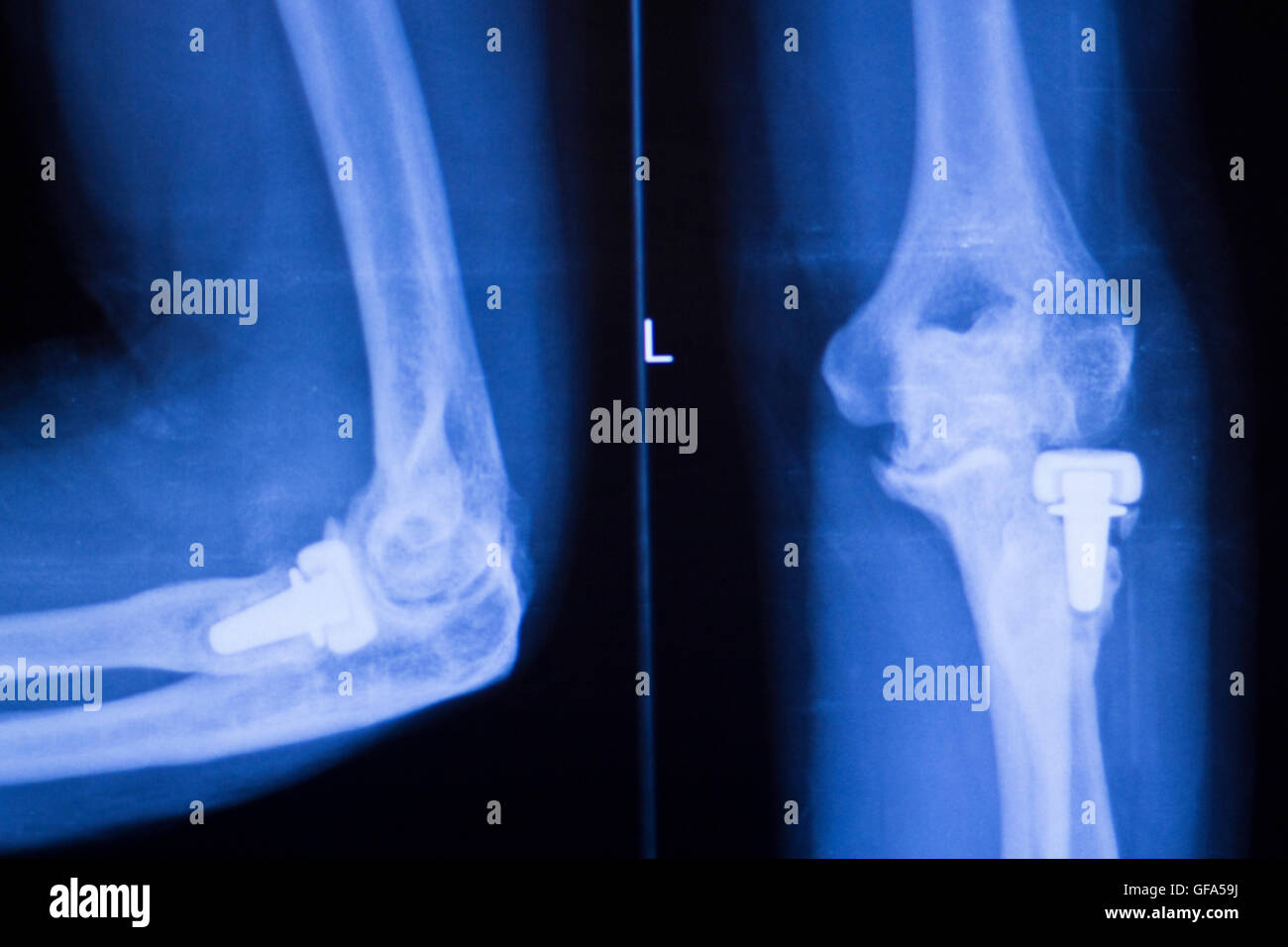 Hip joint replacement orthopedic titanium metal Traaumatology ball and