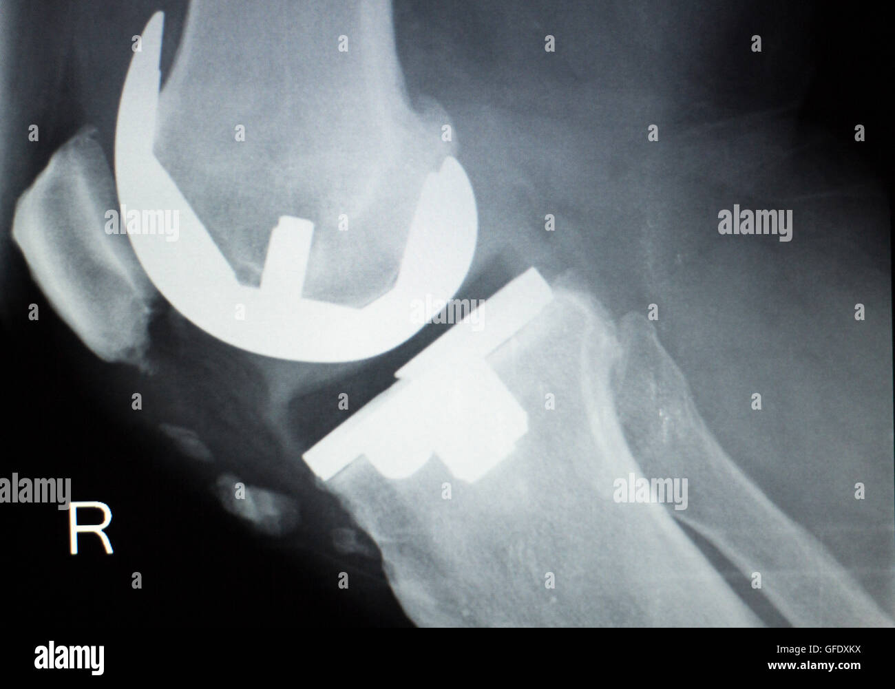 Knee joint replacement orthopedic titanium metal Traaumatology ball and