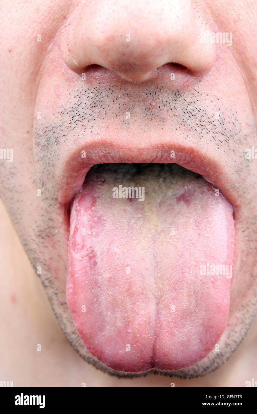 Anemia tongue hires stock photography and images Alamy