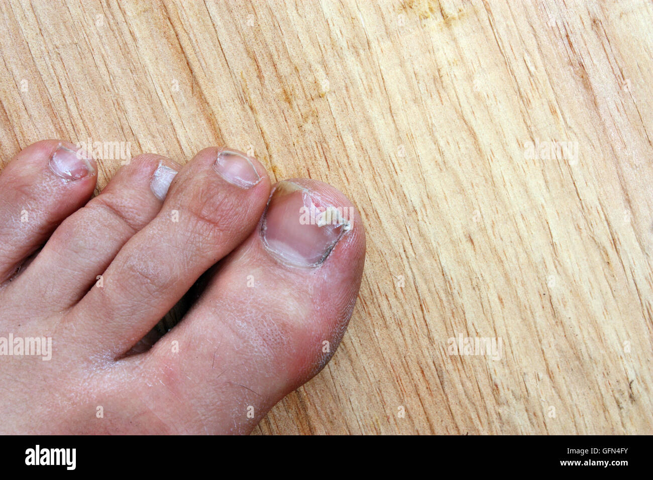 Split toenail deals
