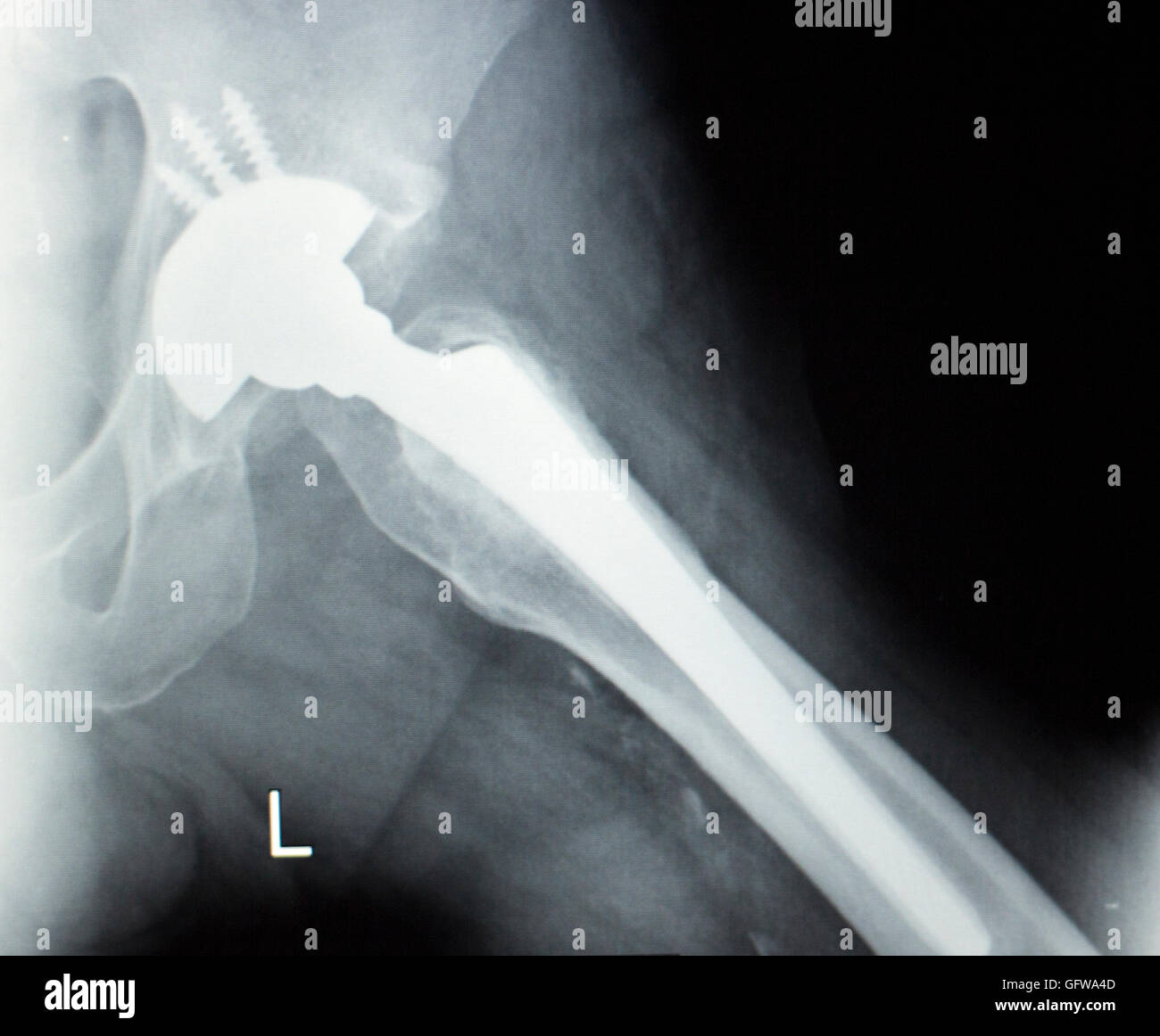 Hip joint replacement orthopedic titanium metal Traaumatology ball and