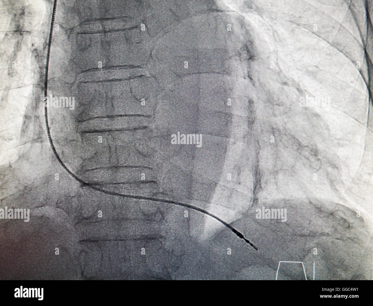 VVIR pacemaker cable in xray image in cardiac catheterization
