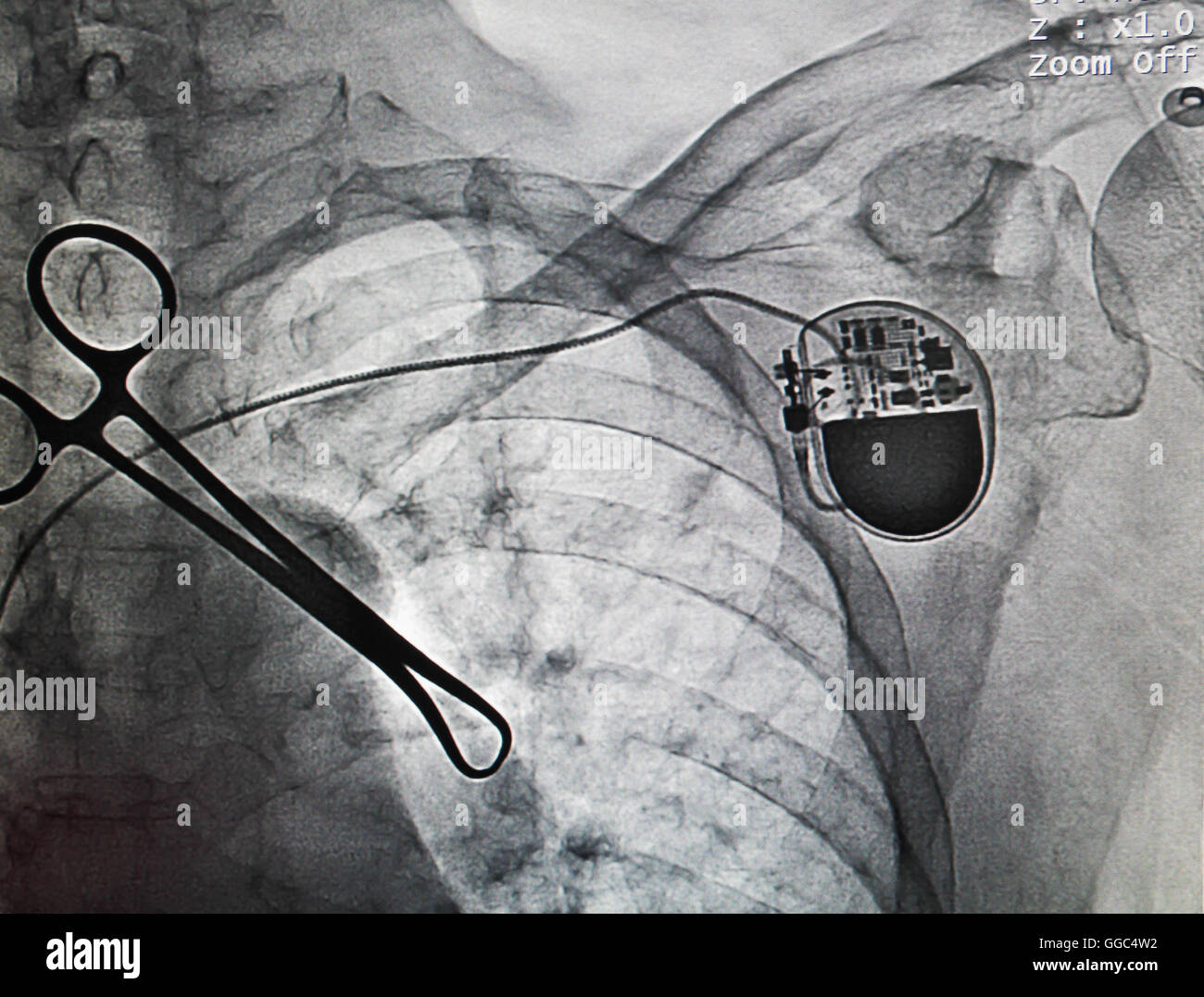 VVIR pacemaker in xray image in cardiac catheterization laboratory