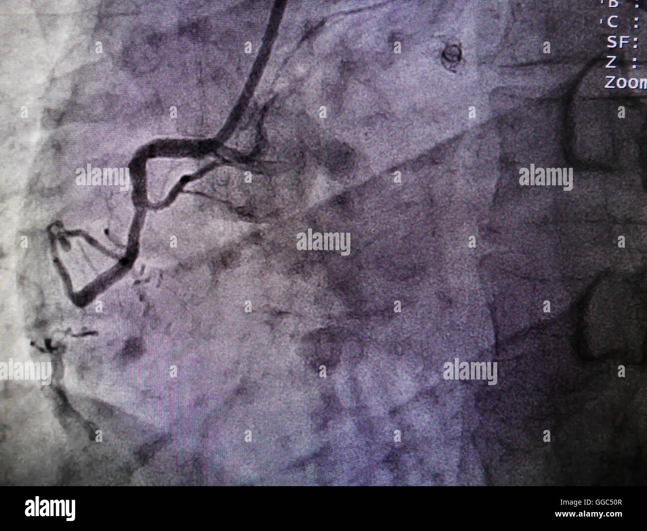 STEMI at right coronary artery from x-ray in cardiac catheterization laboratory Stock Photo