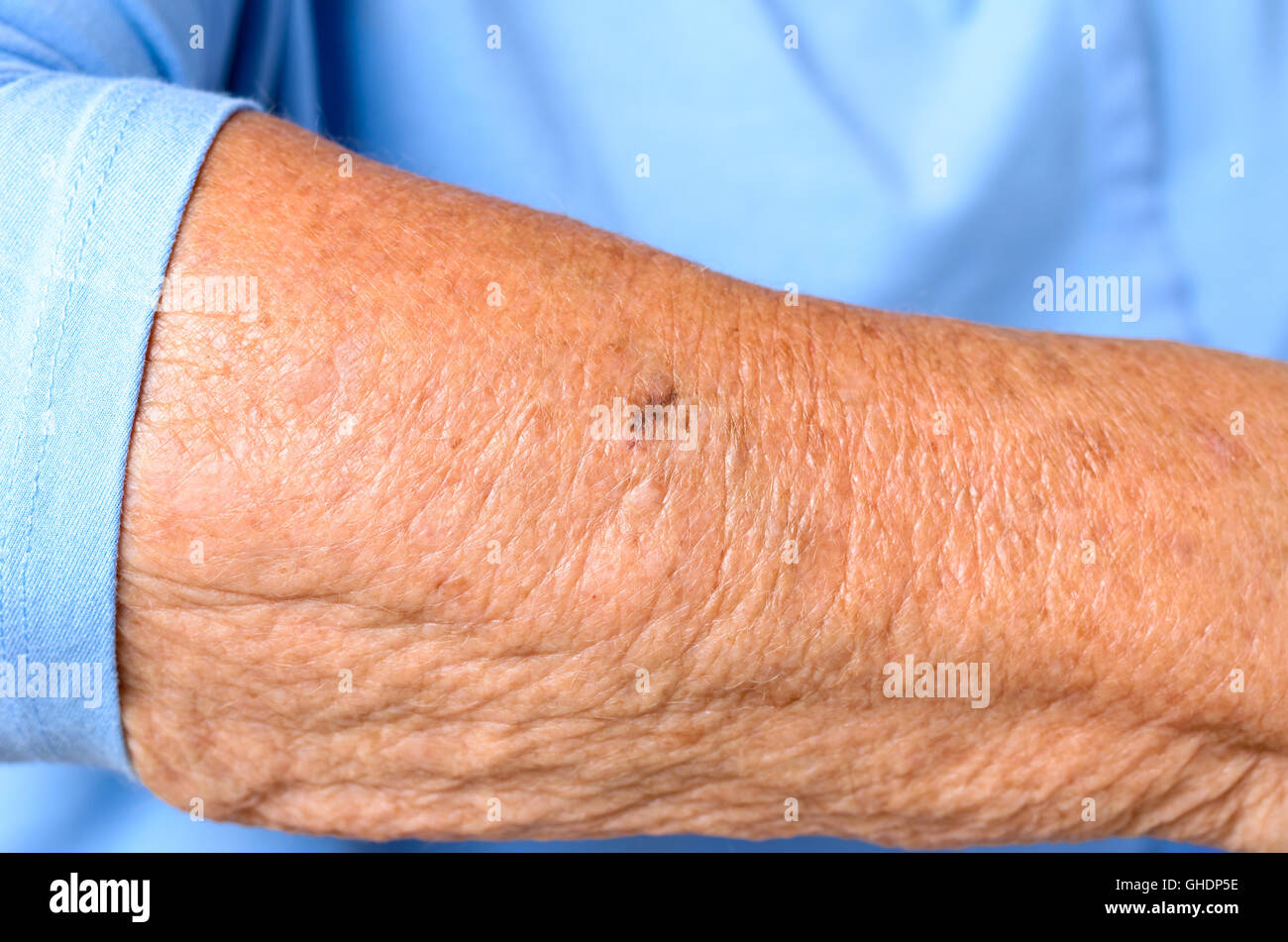 Close Up Detail Of The Forearm Of An Elderly Woman Showing The Wrinkles And Age Spots Of The Skin In A Sign Of Old Age And Loss Stock Photo Alamy Close Up Detail Of The Forearm Of An Elderly Woman Showing The Wrinkles And Age Spots Of The Skin In A Sign Of Old Age And Loss Stock Photo Alamy