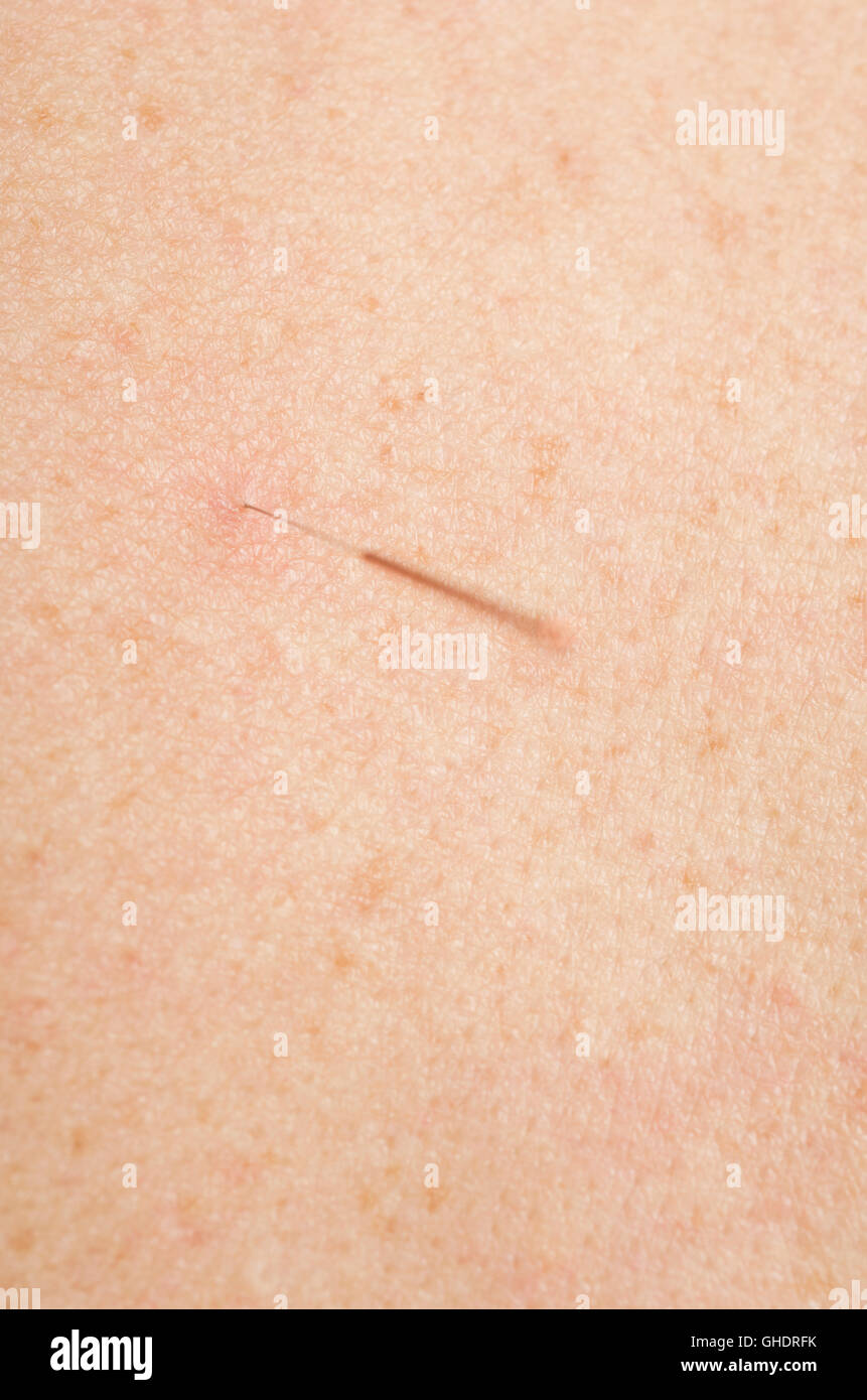 Acupuncture center hi-res stock photography and images - Alamy