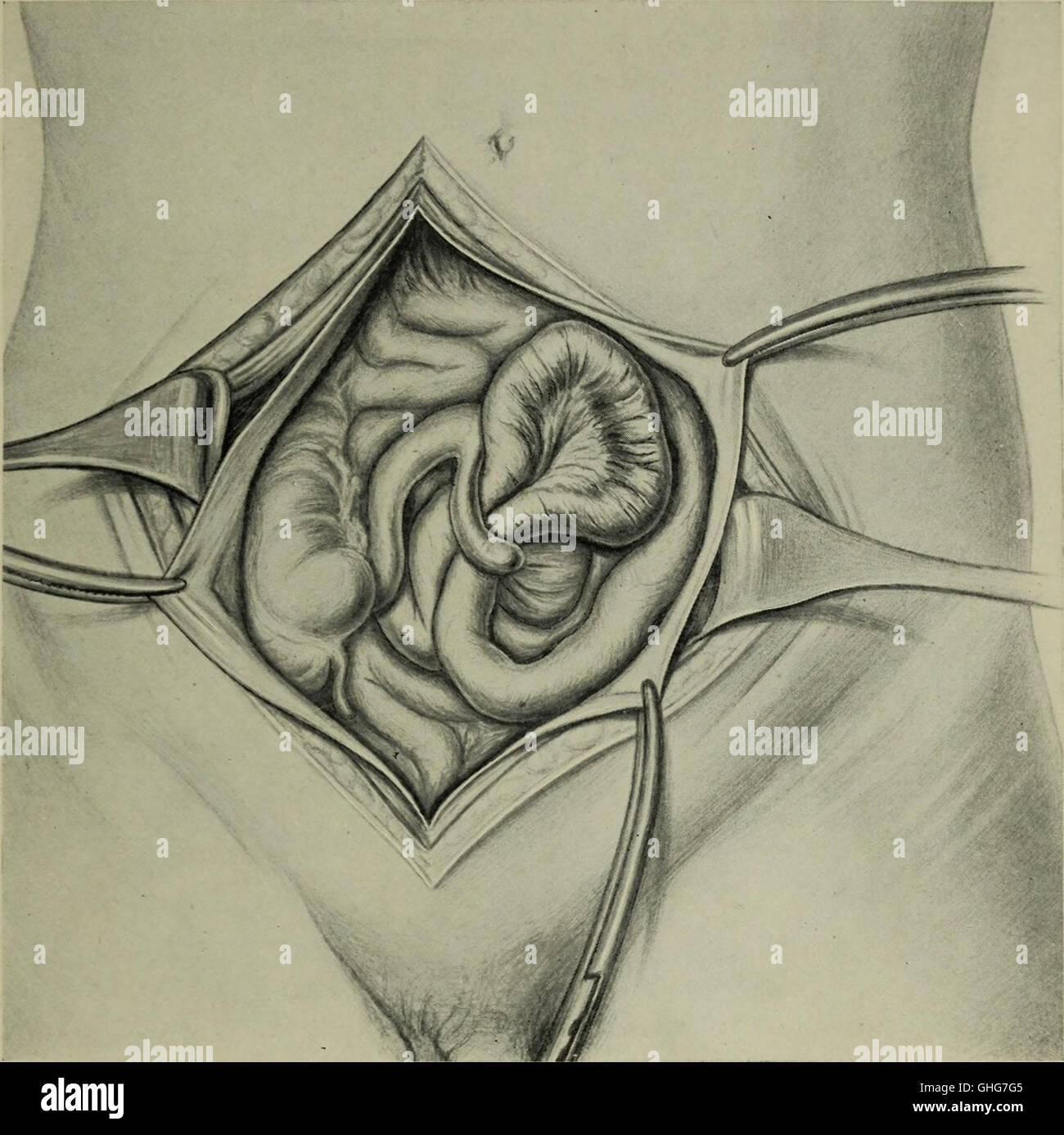 Transaction Surgery The 1920 volume of 'Transactions of the Southern Surgical and ...