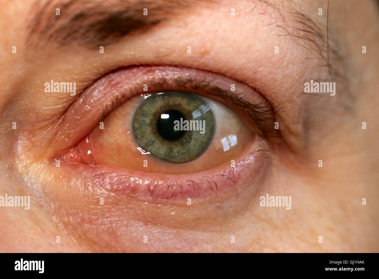 Left eye with irritation or allergic reaction. Stock Photo