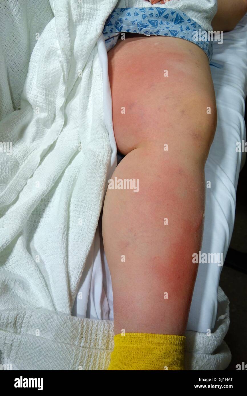 Female patient with deep vein thrombosis as well as cellulitis in left leg. Stock Photo