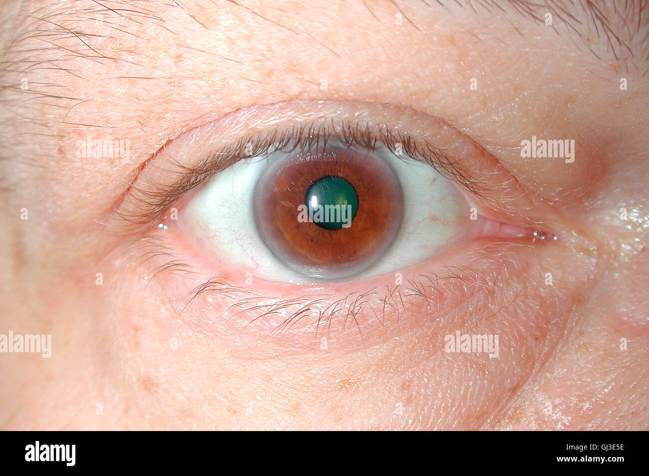 Eye Cholesterol is caused by fat deposits deep in the edge of the cornea.  It is not related to high cholesteroL Stock Photo - Alamy