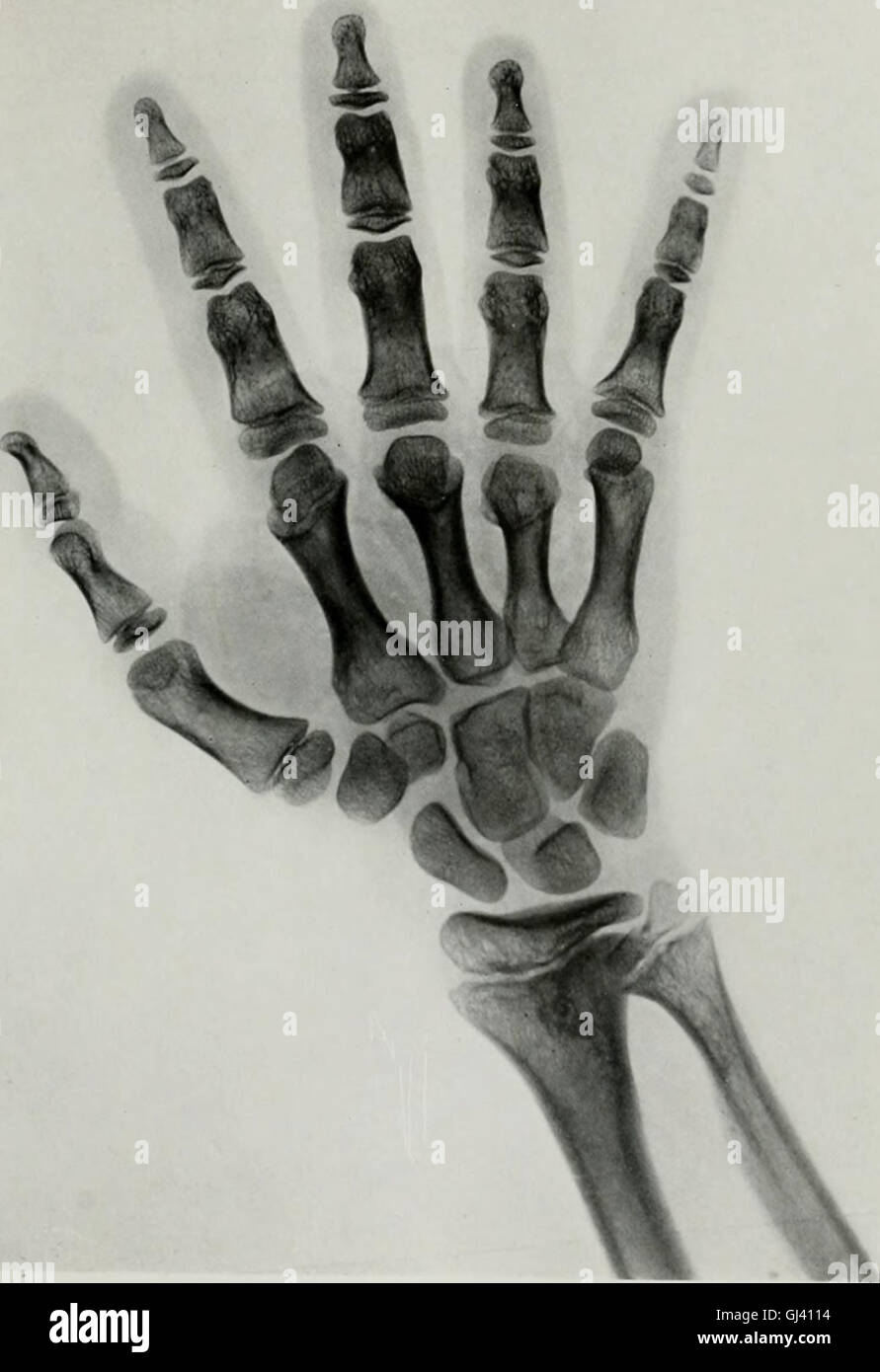 Living anatomy and pathology; the diagnosis of diseases in early life by the Roentgen method (1910) Stock Photo
