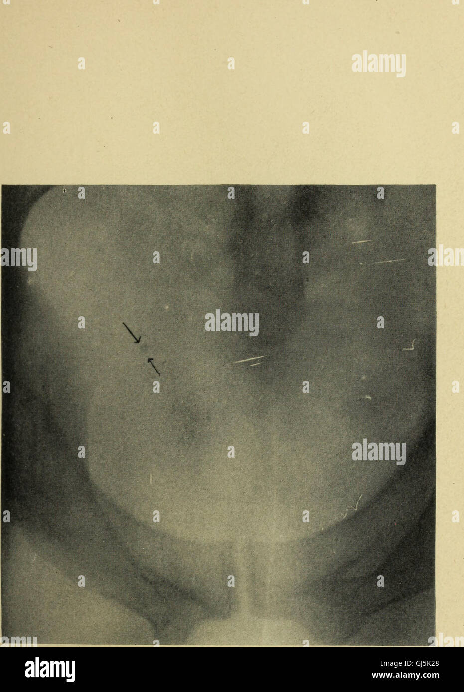Transaction Surgery The 1910 edition of the Transactions of the Southern Surgical and ...