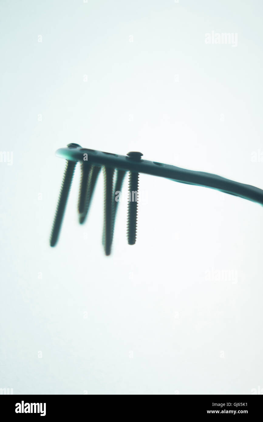 Orthopedics and Traumatology surgery plate & screws surgical titanium
