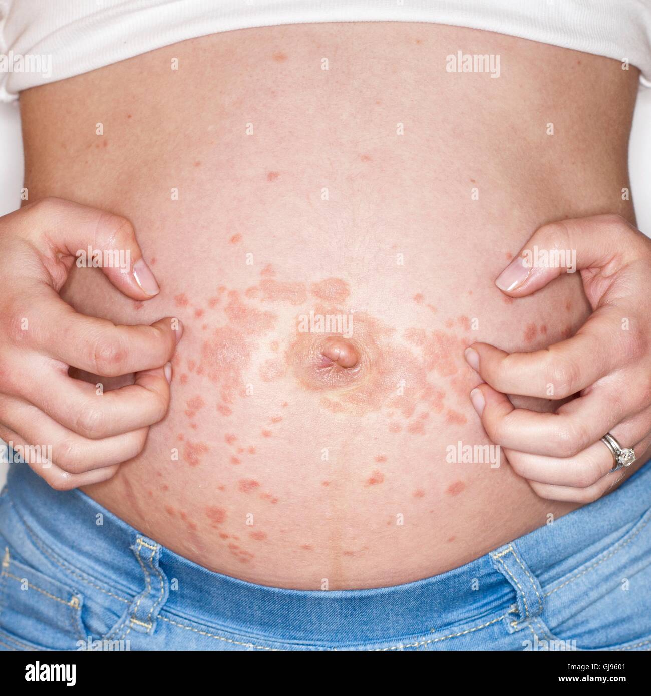 MODEL RELEASED. Pregnant woman scratching rash on tummy. Stock Photo