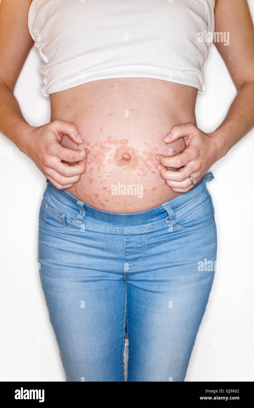 MODEL RELEASED. Pregnant woman scratching rash on tummy. Stock Photo