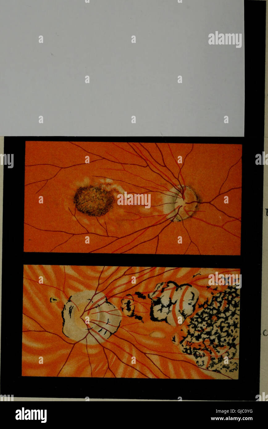 Atlas and epitome of ophthalmoscopy and ophthalmoscopic diagnosis (1910