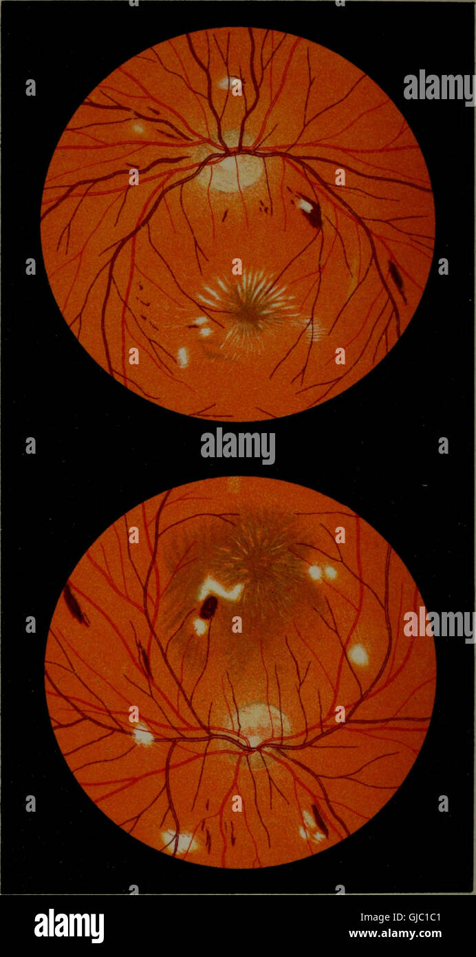 Atlas and epitome of ophthalmoscopy and ophthalmoscopic diagnosis (1910