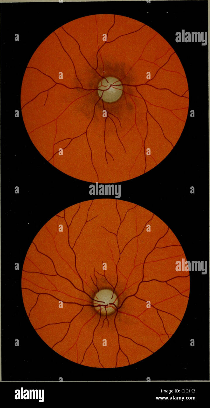 Atlas and epitome of ophthalmoscopy and ophthalmoscopic diagnosis (1910