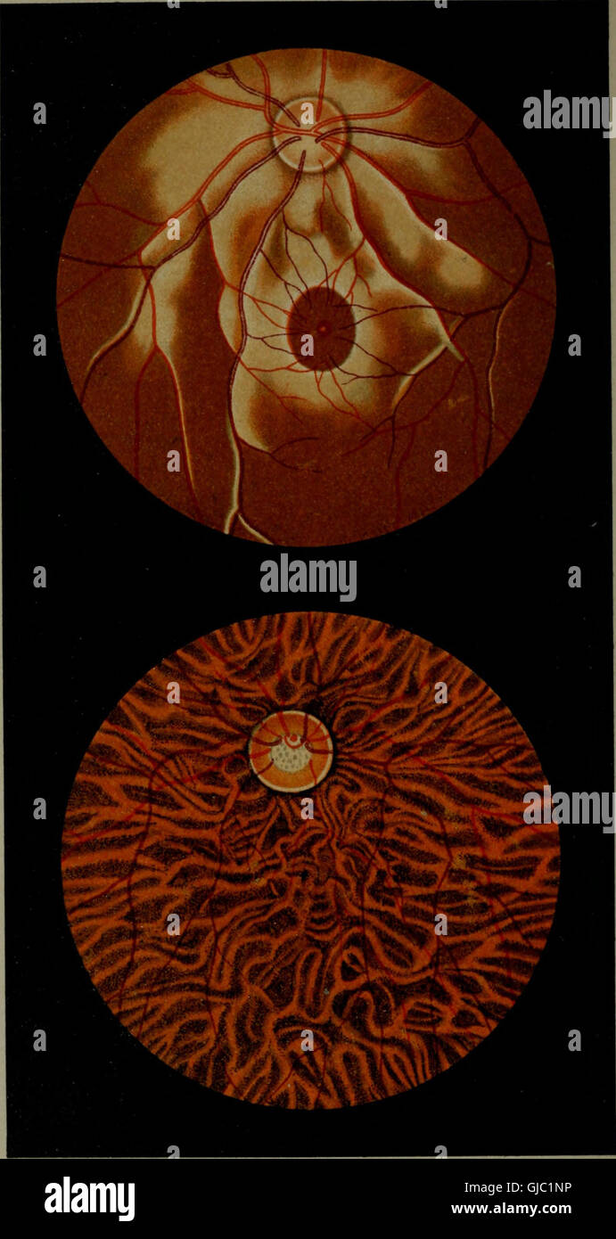 Atlas and epitome of ophthalmoscopy and ophthalmoscopic diagnosis (1910