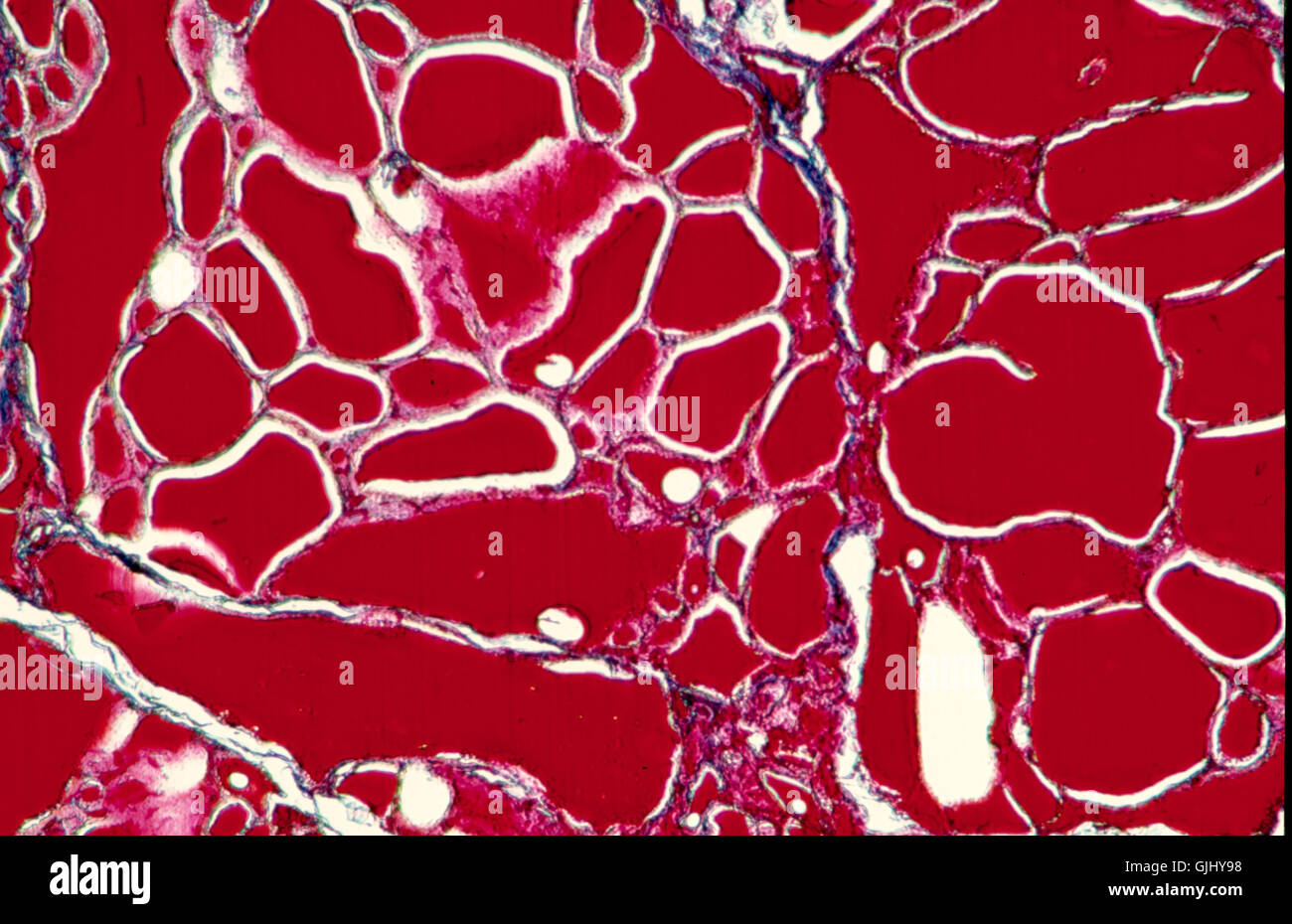 microscope microscopic goiter Stock Photo