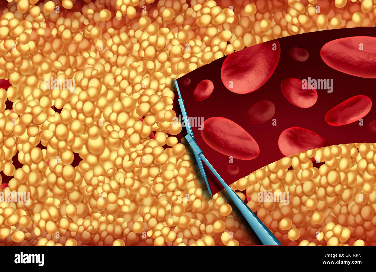 Removing cholesterol and cleaning arteries medical concept as a wiper